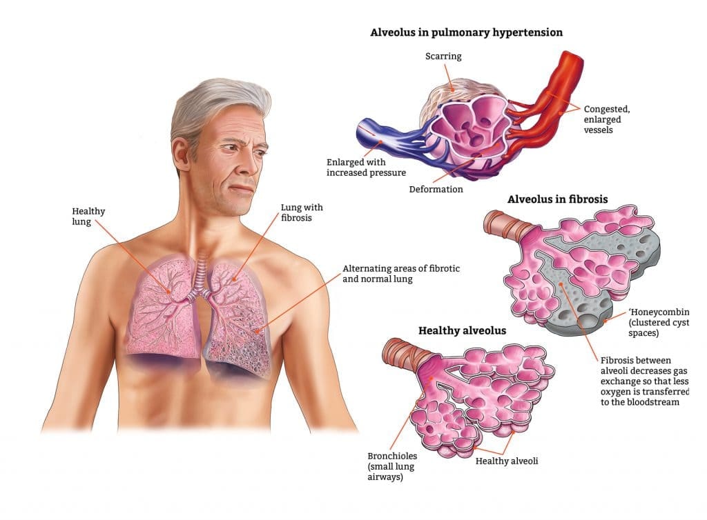 Stem Cell Therapy for Liver Cirrhosis